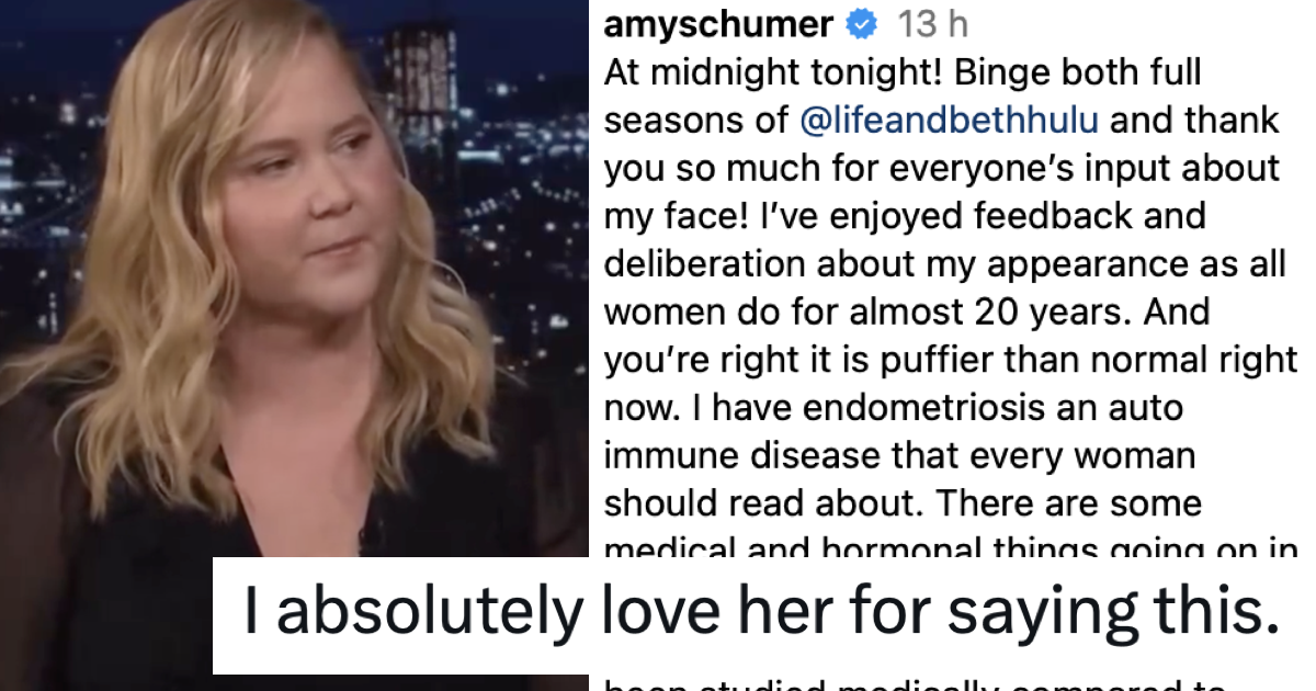 Amy Schumer had the very best response to trolls wanging on about her ‘puffier’ face